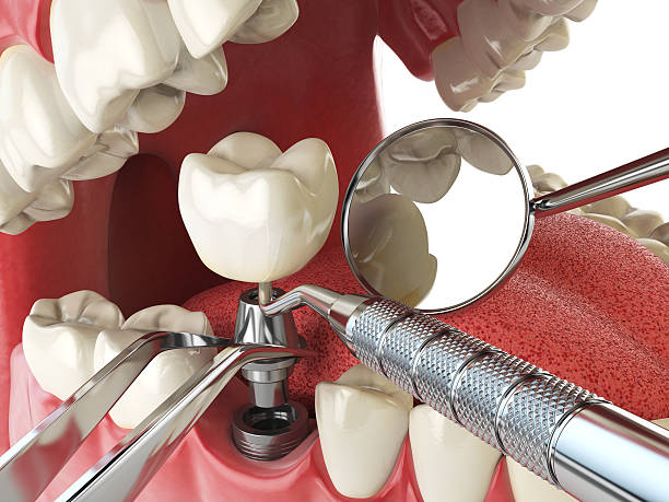 Best Emergency Broken Tooth Repair in Leitchfield, KY